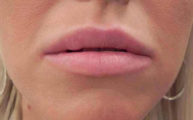 עיבוי שפתיים ללא ניתוח 4