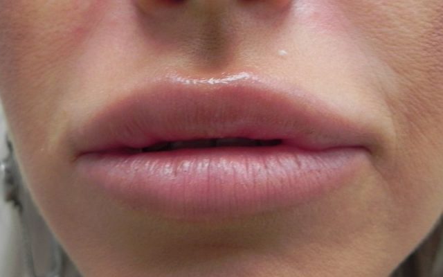 עיבוי שפתיים ללא ניתוח 6