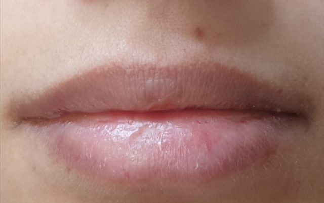 עיבוי שפתיים ללא ניתוח 12