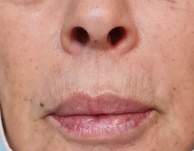 עיבוי שפתיים ללא ניתוח 14