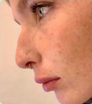 פיסול פנים ללא ניתוח 5