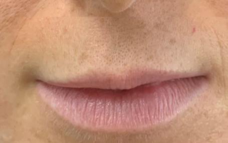 עיבוי שפתיים ללא ניתוח 17