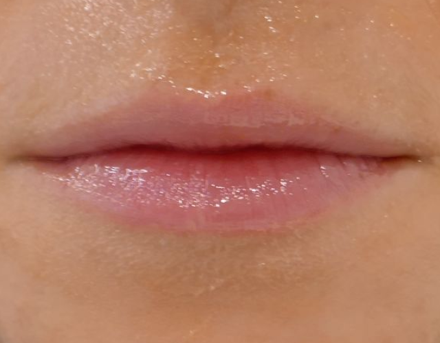 עיבוי שפתיים ללא ניתוח 19
