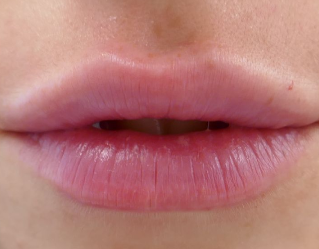 עיבוי שפתיים ללא ניתוח 20